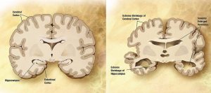 Alzheimerova demence - vliv na mozek
